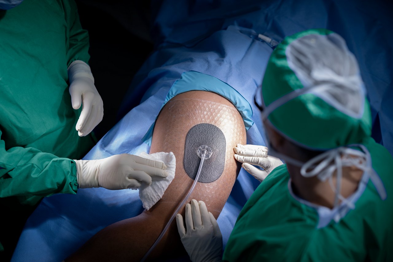 Placering af 3M™ V.A.C.® Peel and Place Dressing og 3M™ SensaT.R.A.C.™ Pad på patient i operationsstuen med kirurg, der glatter forbindingen. Solventum Branding, Produkt Applikationsbillede, rgb, tif