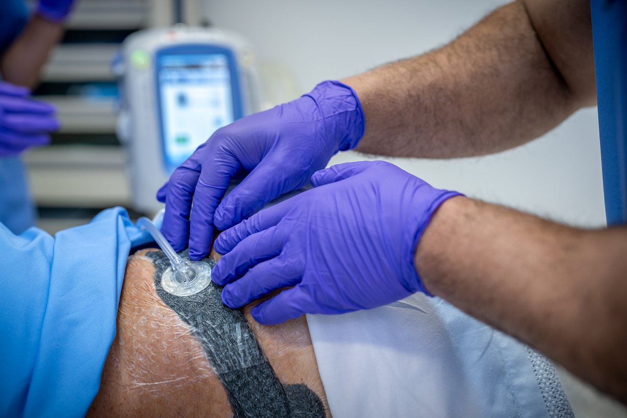 3M™ V.A.C.® Ulta Therapy Unit with 3M™ V.A.C.® Granufoam™ Dressing in ICU, Product Application, People Image, rgb, tif
