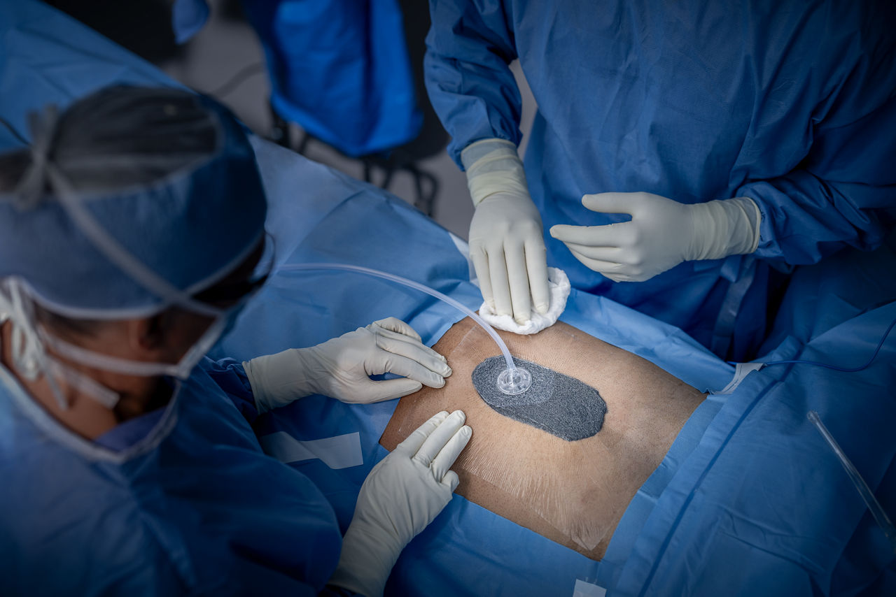 Patient with abdomen wound receiving therapy in OR with 3M™ V.A.C.® Ulta Therapy Unit with 3M™ V.A.C.® Drape and 3M™ V.A.C.® Granufoam™ Dressing in OR., rgb, tif