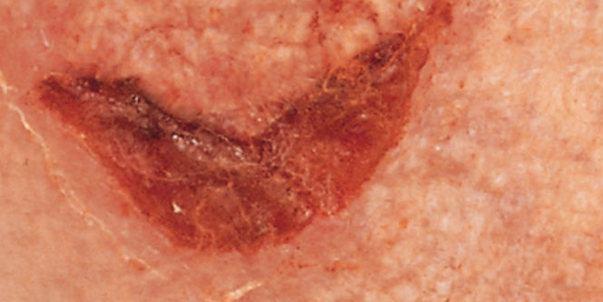 Medical Adhesive-Related Skin Injury (MARSI)