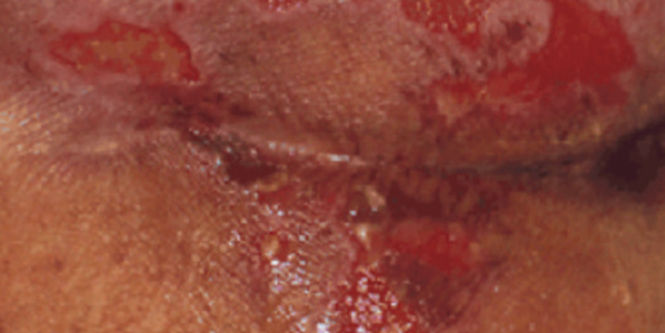 Pressure Ulcer/Injury