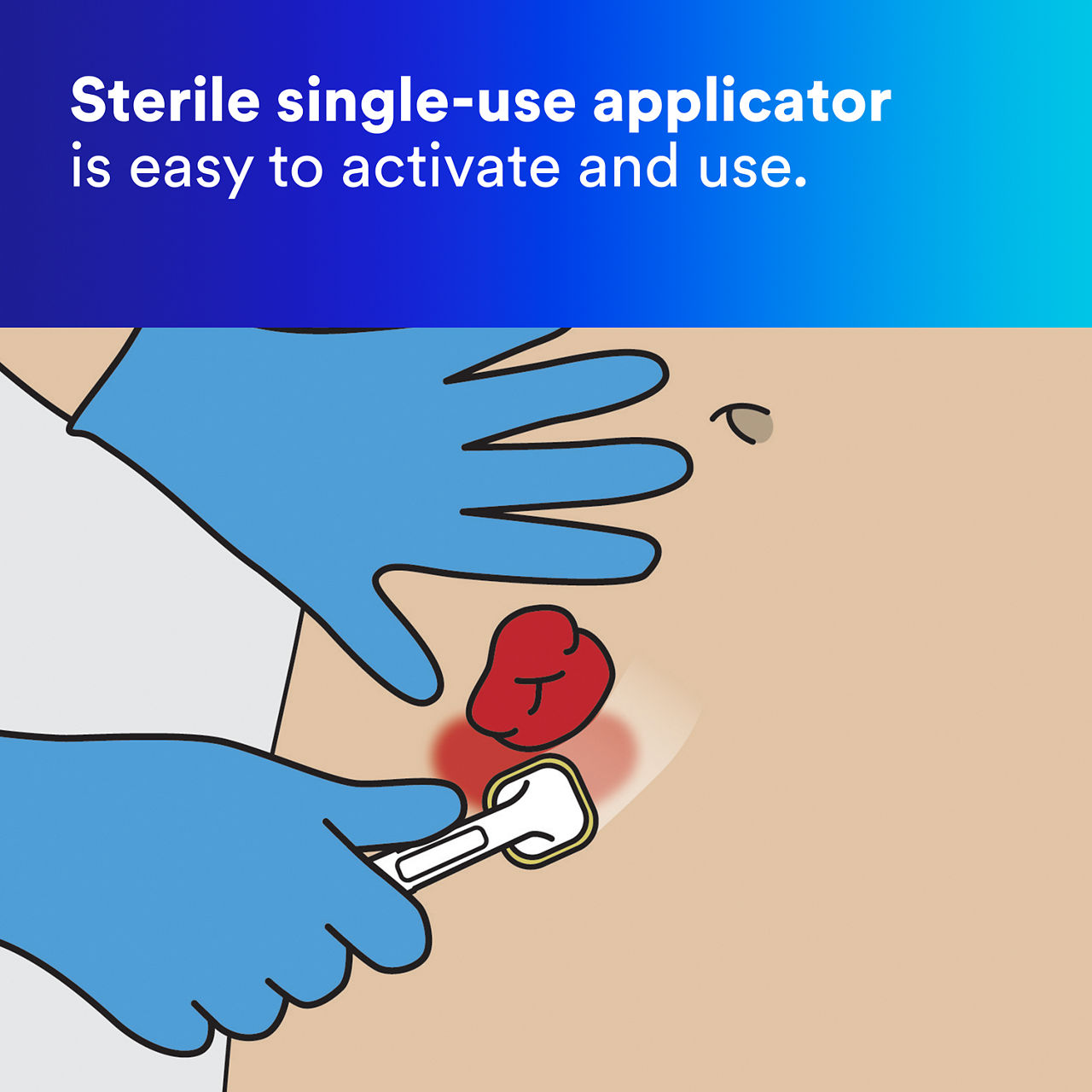 (5) Cavilon Advanced Skin Protectant: Sterile single-use applicator is easy to activate and use