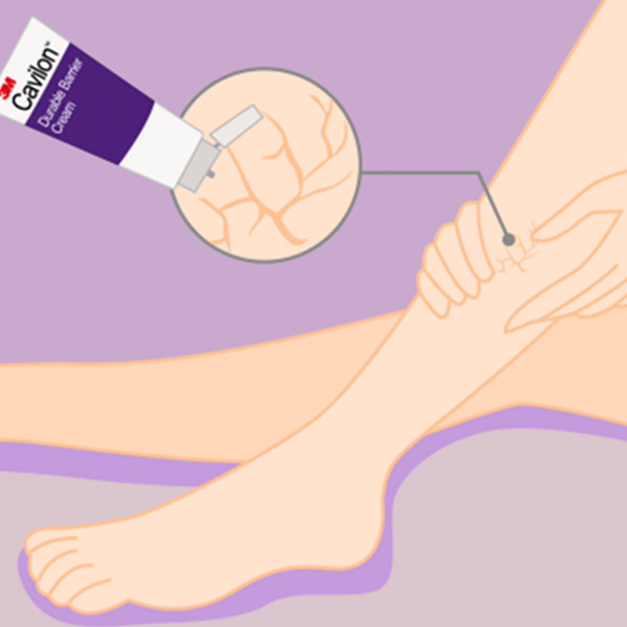 Trouvez la solution optimale pour vos besoins en matière d’intégrité de la peau