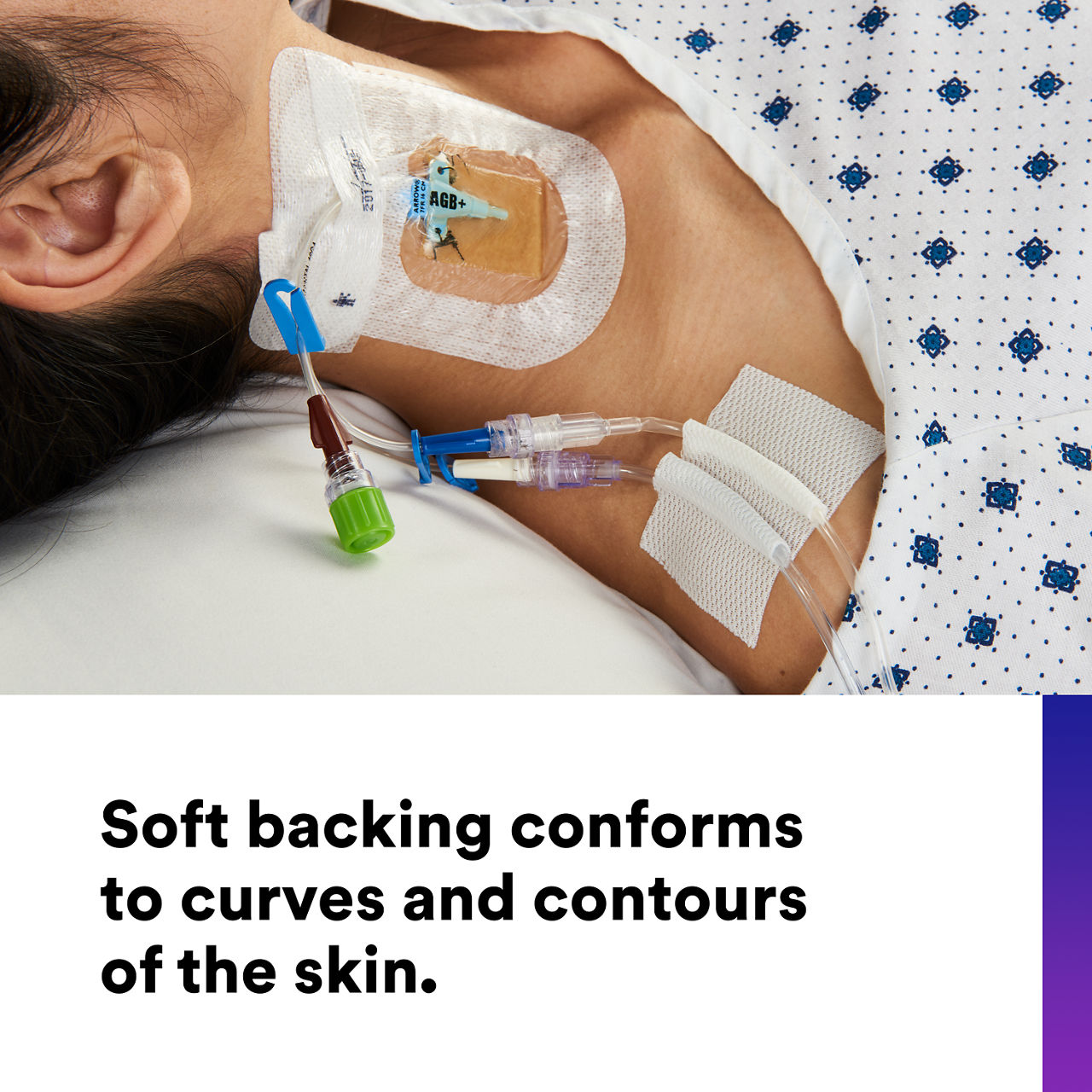 (4) Multipore Dry Surgical tape: Soft backing conforms to curves and contours of the skin