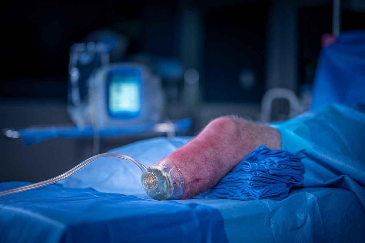 Application of 3M™ V.A.C. Veraflo Cleanse Choice™ Dressing and 3M™ V.A.C.® Advanced Drape to amputated leg.