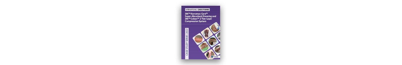 3M™ Kerramax Care™ Superabsorberend Verband en 3M™ Coban™ 2 Lagen Compressiesysteem Thumbnail van de Casusreeks