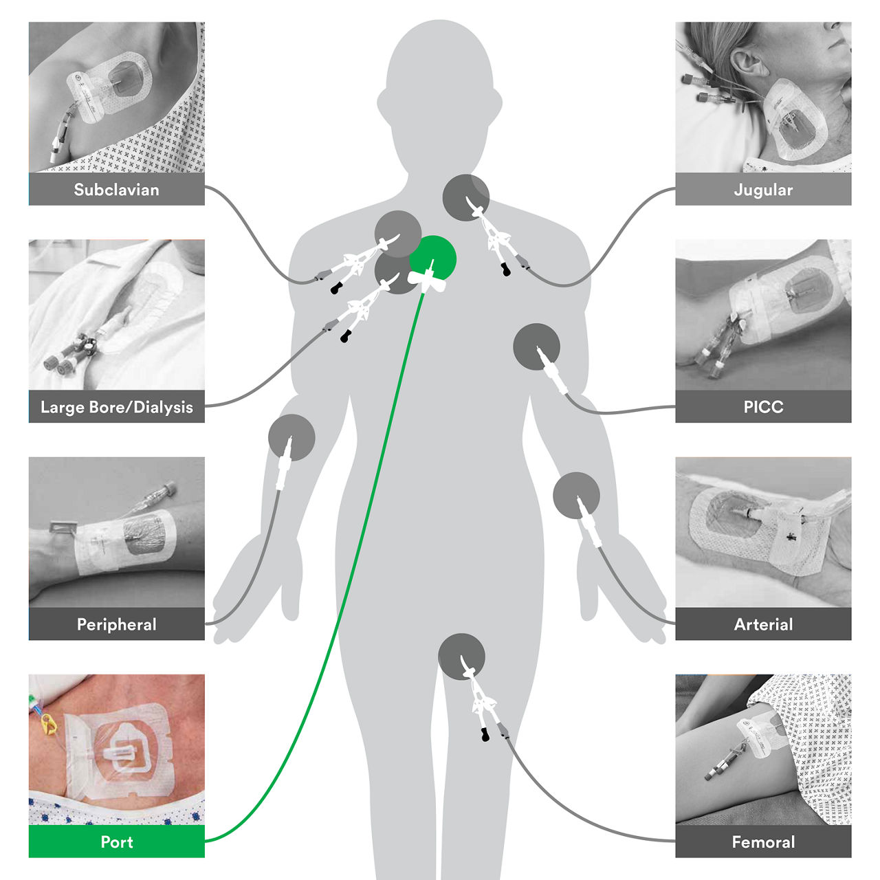 Help to reduce risks across extraluminal access points