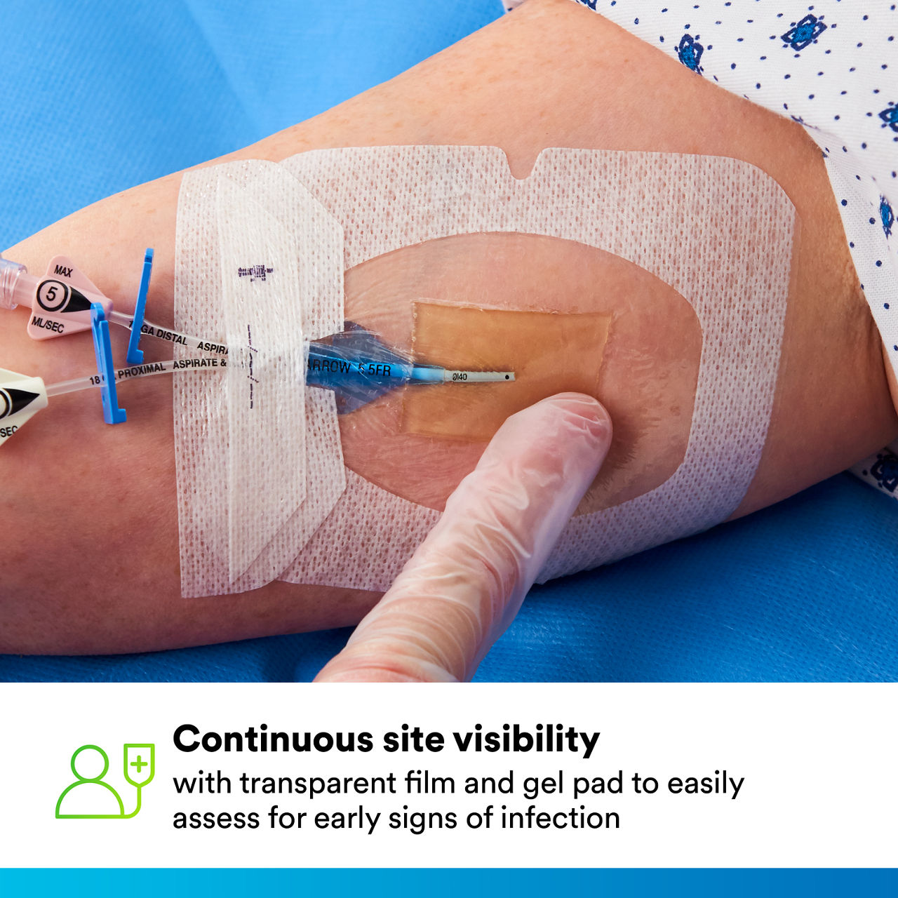 (5) Tegaderm CHG IV Securement 1658: Continuous site visibility