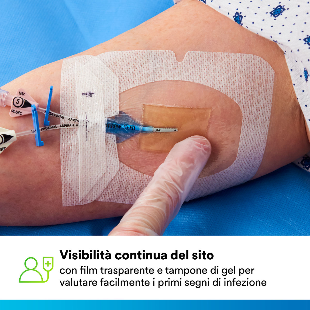 (5) Tegaderm CHG IV Securement 1658: Continuous site visibility