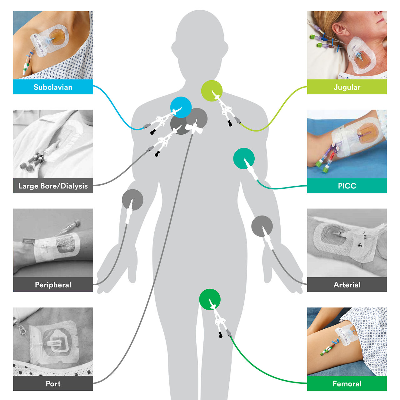 Help to reduce risks across extraluminal access points