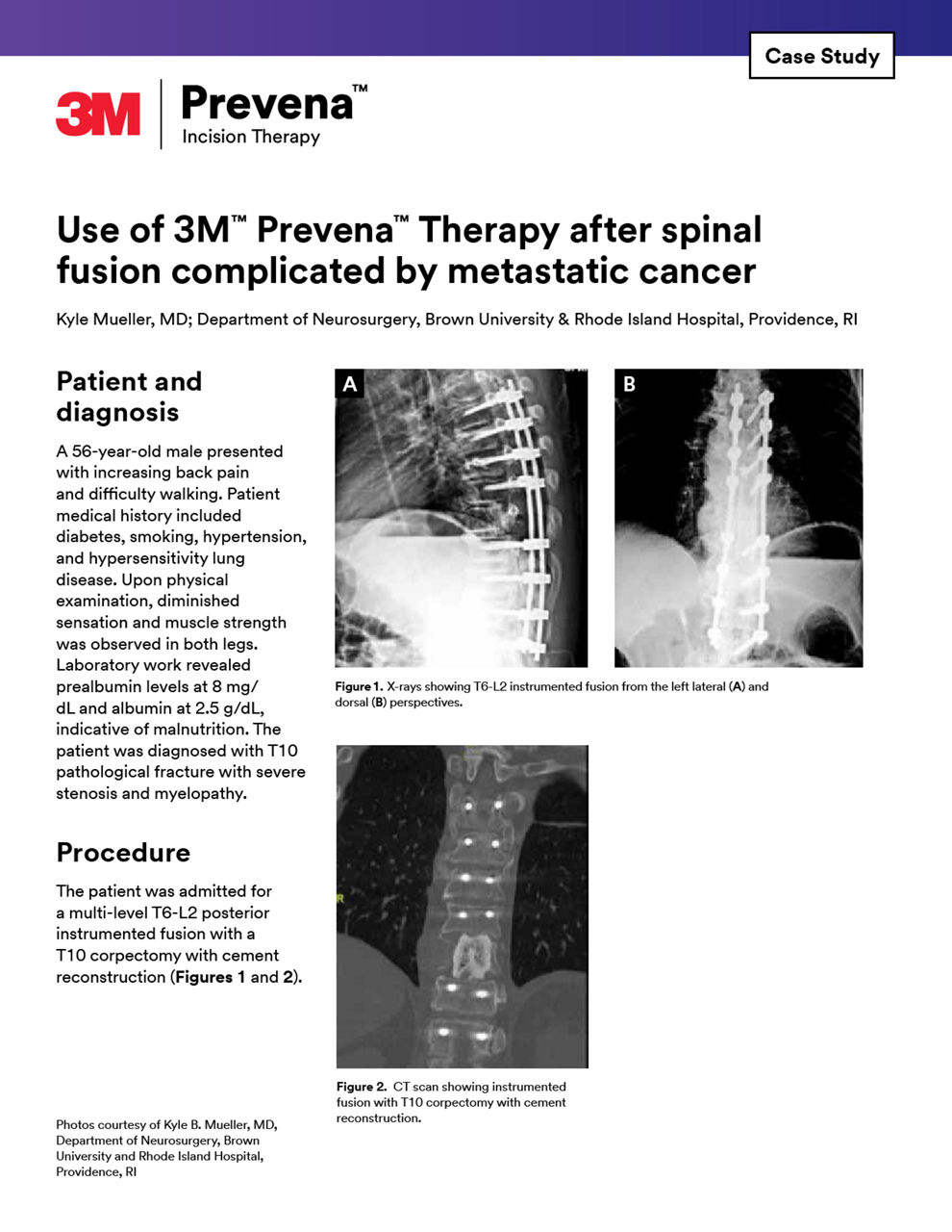 Prevena Therapy after spinal infusion complicated by metastatic cancer case study cover preview