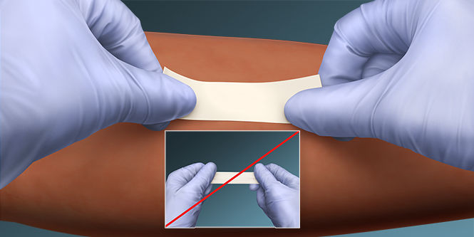 Apply tape to skin without pulling or stretching

