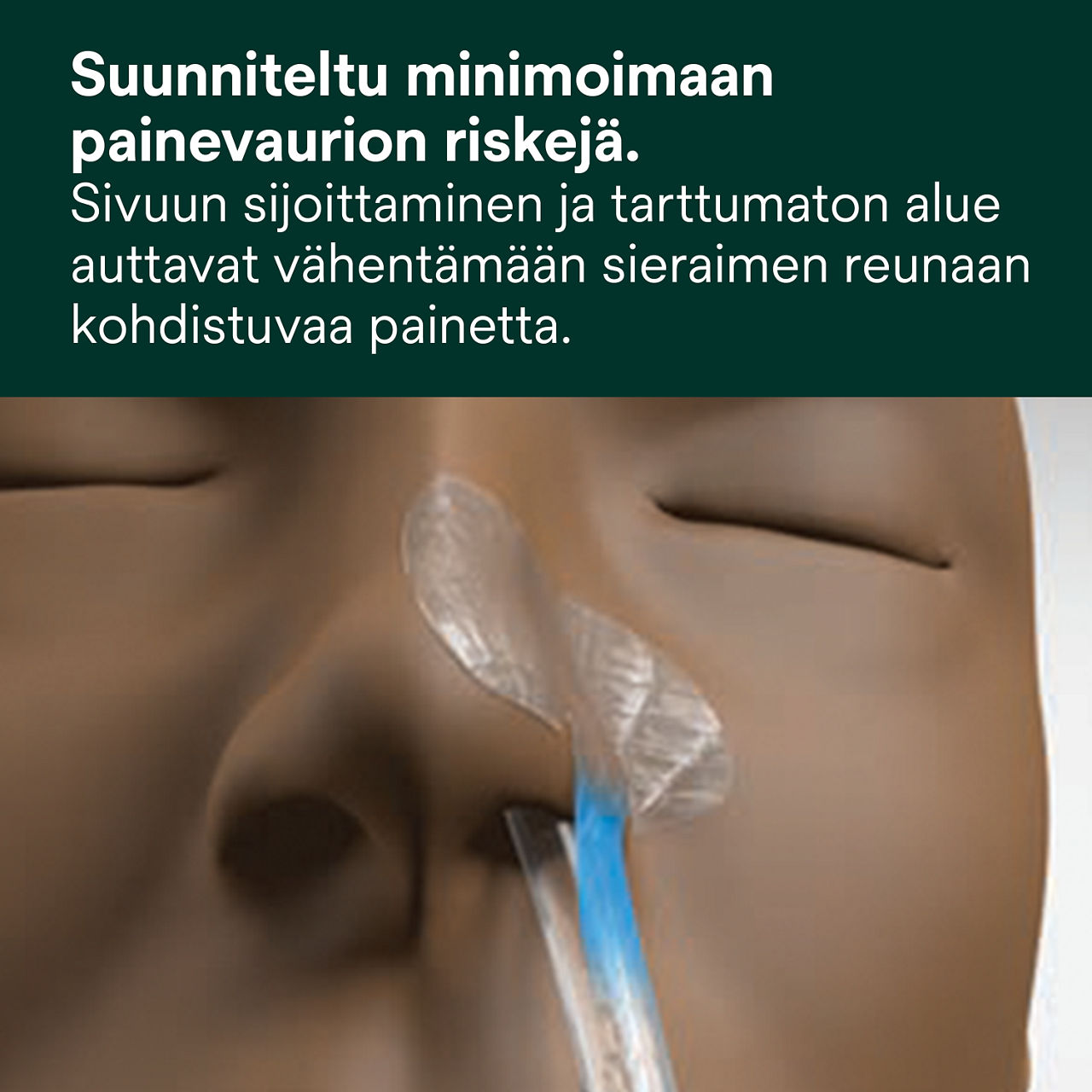 (1) Nenä-mahaletkun kiinnitystarvike: Suunniteltu vähentämään painevaurion riskiä
