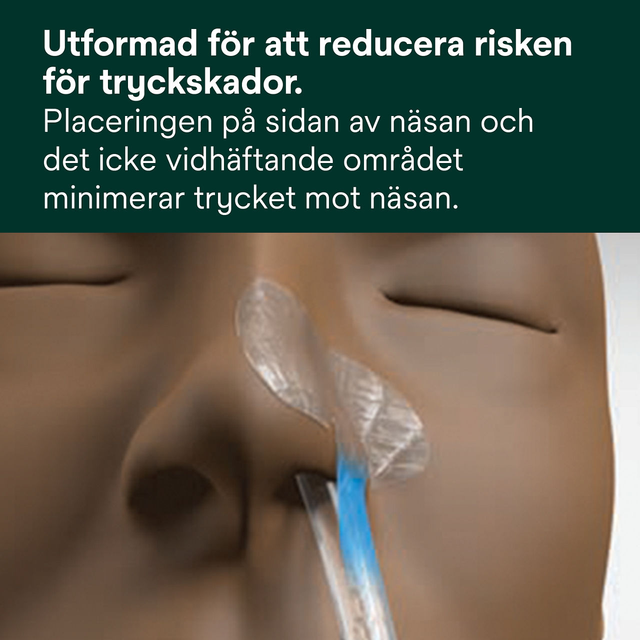 (1) Nasogastrisk fixeringsenhet: Designad för att bidra till att minska risken för tryckskador