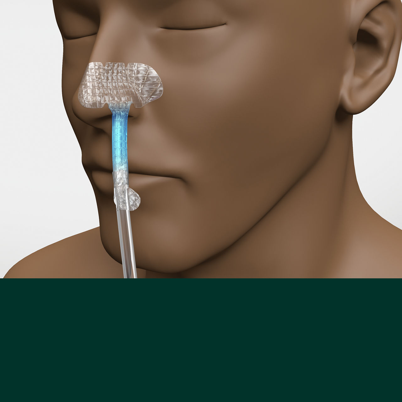 (4) Nazogastrik Sabitleme Cihazı: Uygulaması kolay ve yapışmaz sekme ile temiz bir şekilde çıkarılır