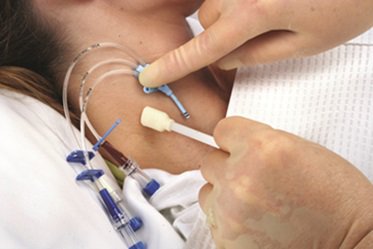 3M™ キャビロン™ 非アルコール性皮膜(製品番号：3343E)の中心静脈カテーテル挿入部位への使用例です。