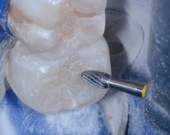 Simple occlusal anatomy is carved with the Q-Finisher® from Komet®