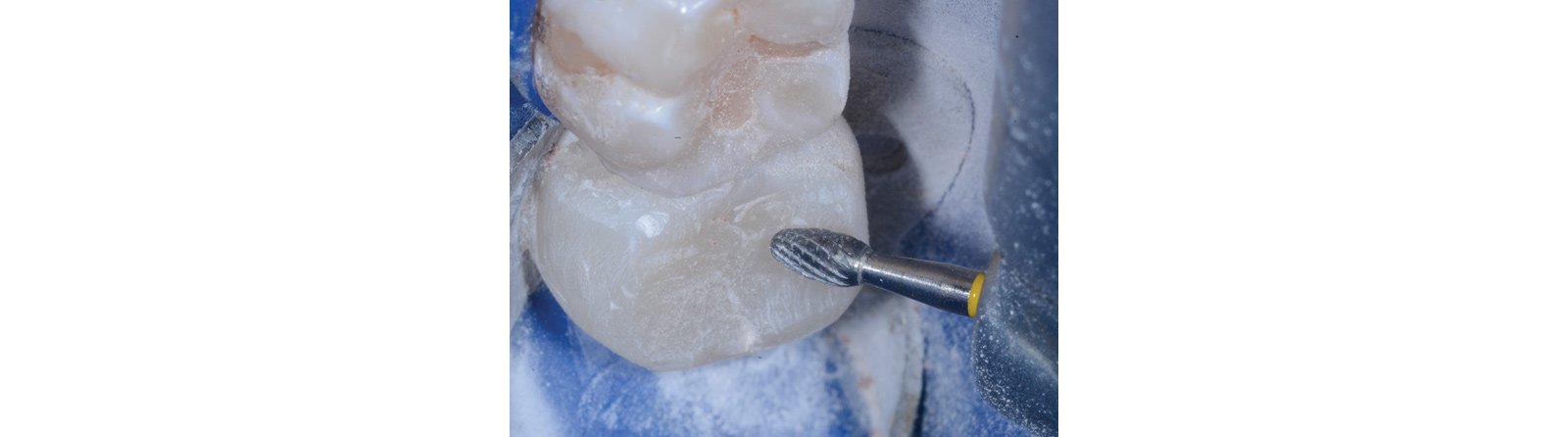Simple occlusal anatomy is carved with the Q-Finisher® from Komet®