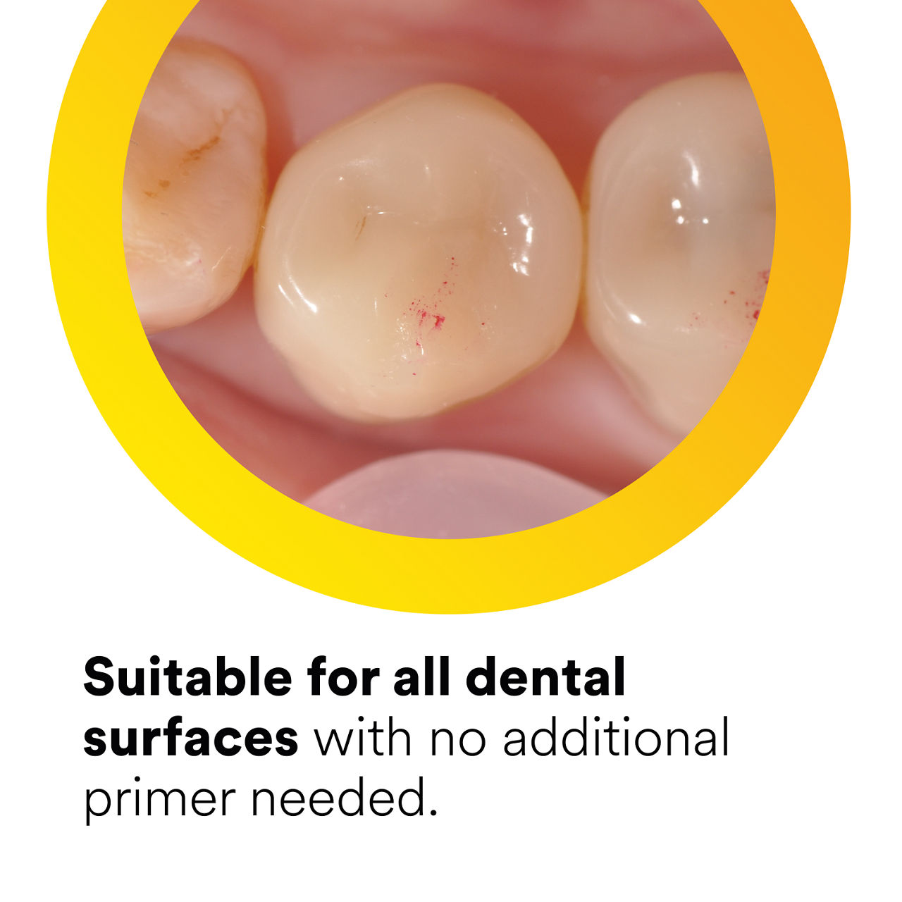 (1) Scotchbond Universal Adhesive: Suitable for all dental surfaces with no additional primer needed