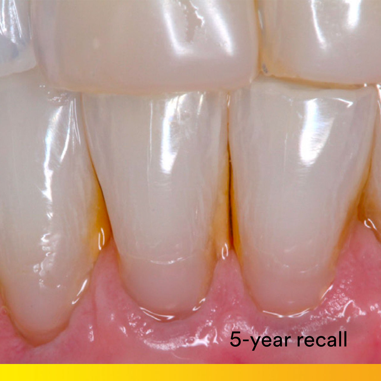 Choose an adhesive backed by five years of clinical proof.