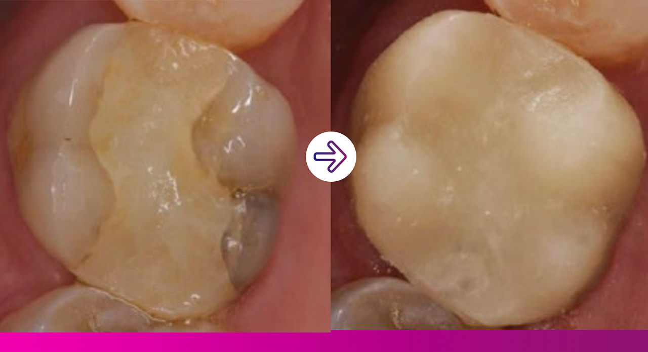 Trusted bond strength for applying a zirconia crown