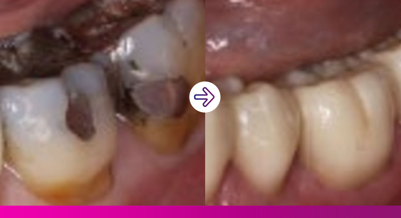 A reliable and simple solution for PFM crown cementation