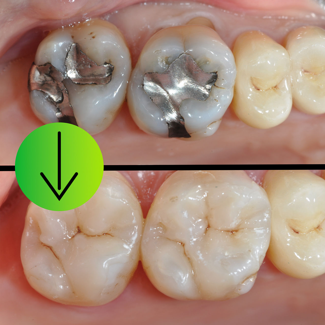 Preserving structure and function with Glass Ceramic Onlays