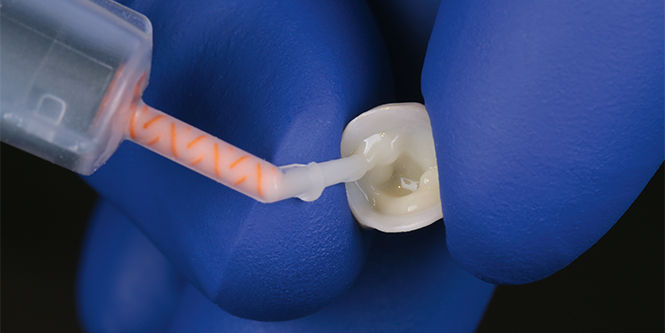 Veneers, adhesiefbruggen