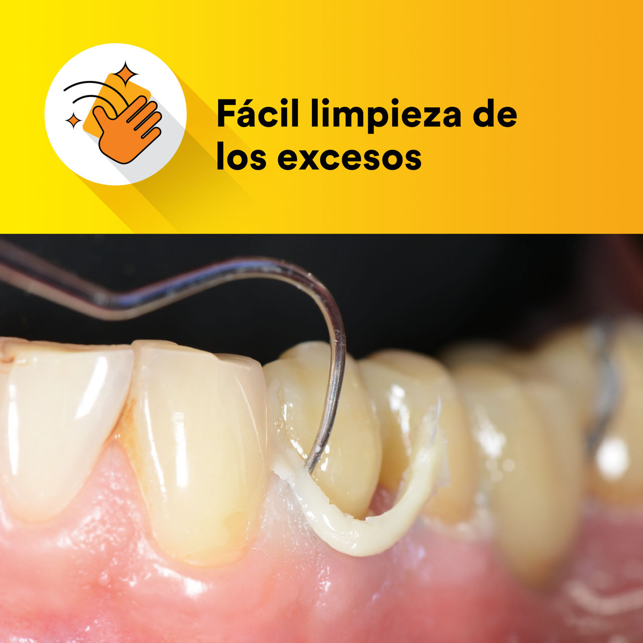 (1) Cemento de resina universal RelyX: fácil limpieza del exceso