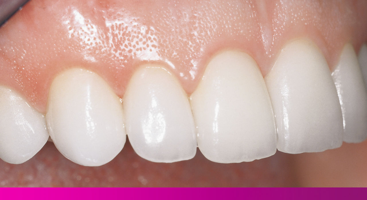 Then, confidently deliver final esthetic results with 3M™ RelyX™ Veneer Cement.