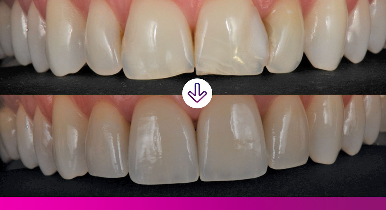 Overcoming an anterior challenge with esthetic results