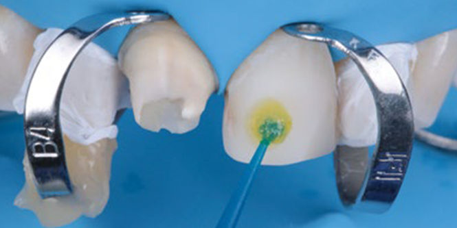 Total-etch adhesive bonding of a glass ceramic veneer and self-adhesive cementation of a zirconia crown.