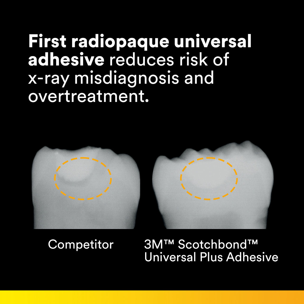 (2) Scotchbond Universal Plus Adhesive: First radiopaque universal adhesive reduces risk of x-ray