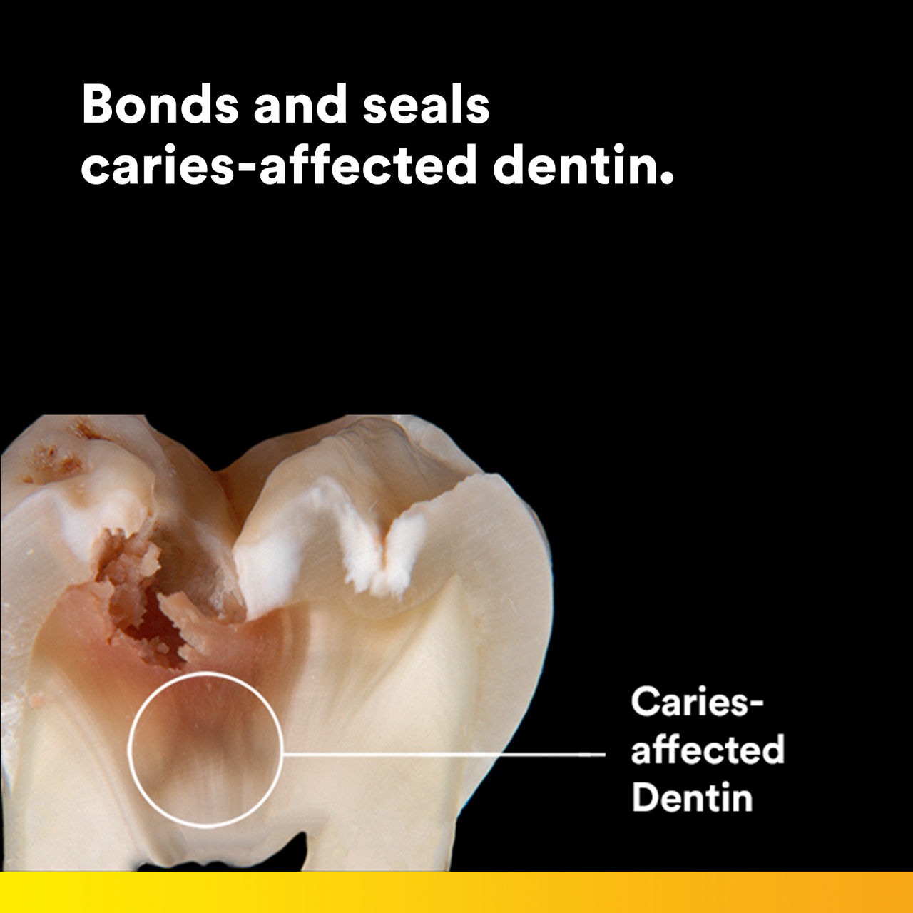 (3) Scotchbond Universal Plus Adhesive: Bonds and seals caries-affected dentin