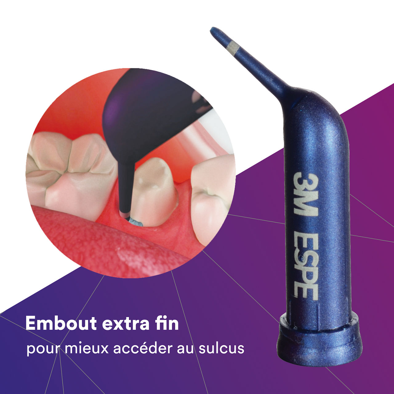 (2) Astringent Retraction Paste: Extra-fine tip