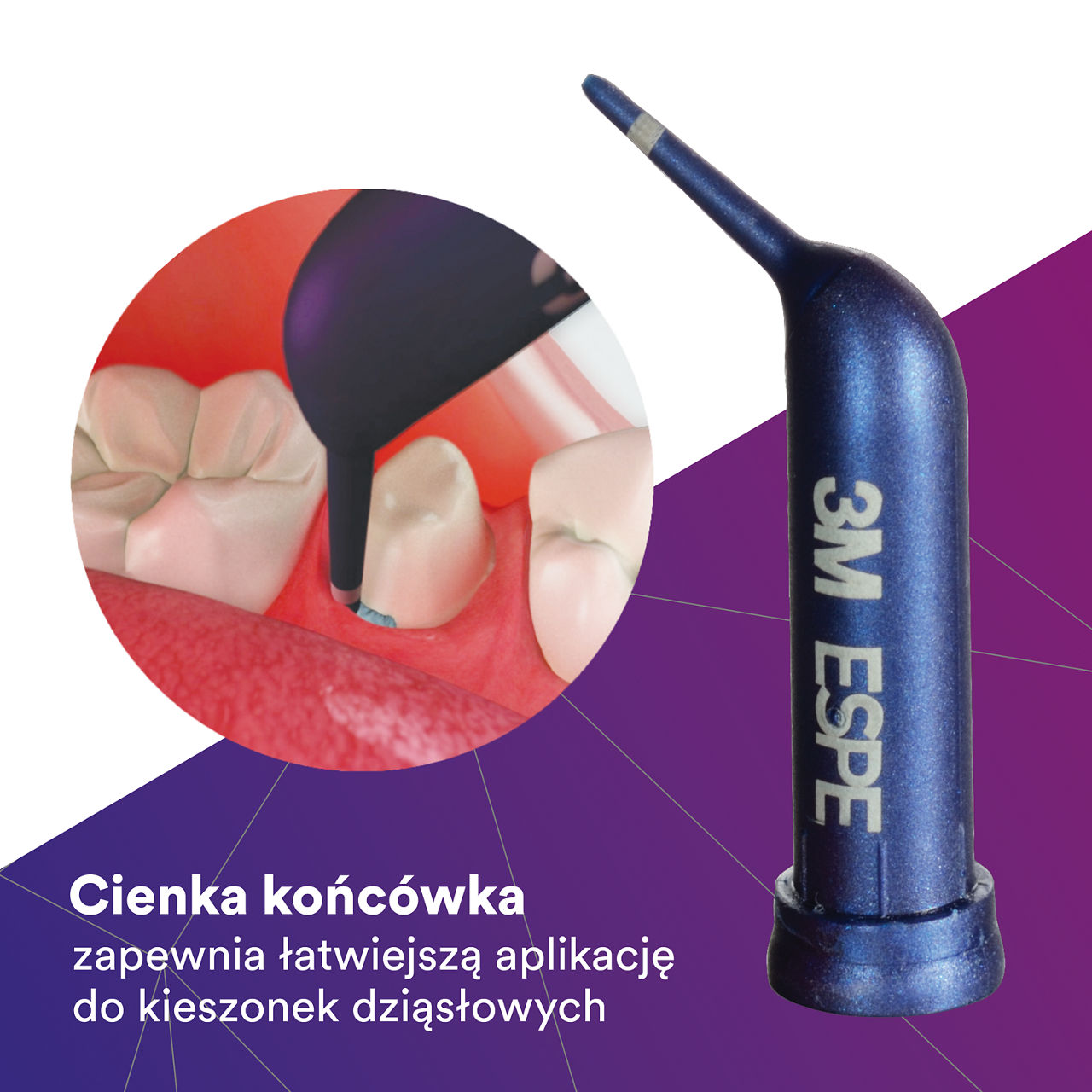 (2) Astringent Retraction Paste: Extra-fine tip