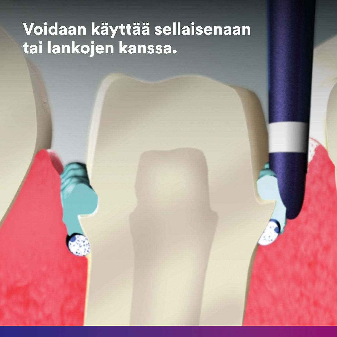 4- - Astringent Retractino Paste