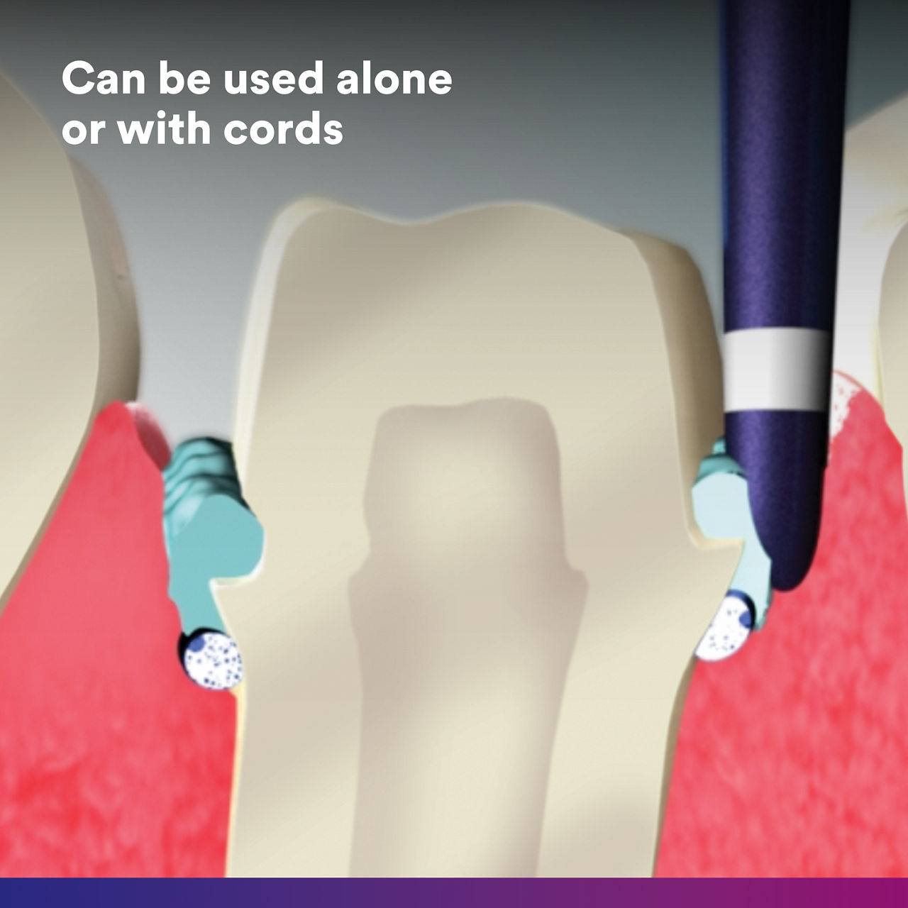 (4) Astringent Retraction Paste: can be used alone or with cords