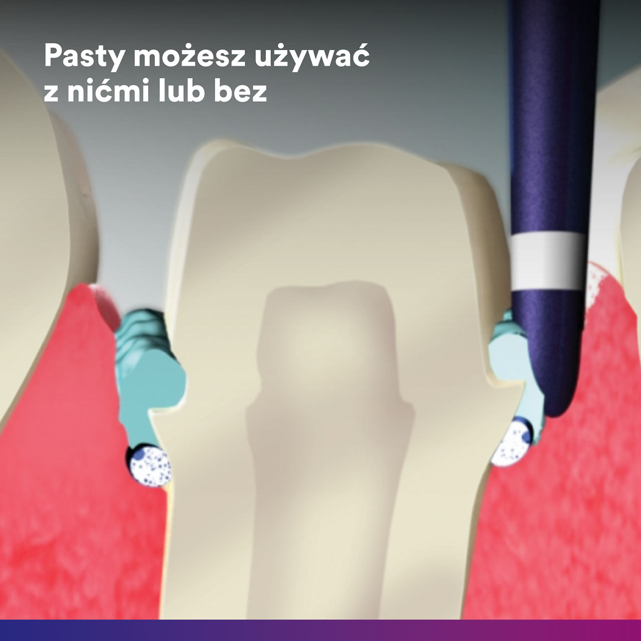 (4) Astringent Retraction Paste: can be used alone or with cords