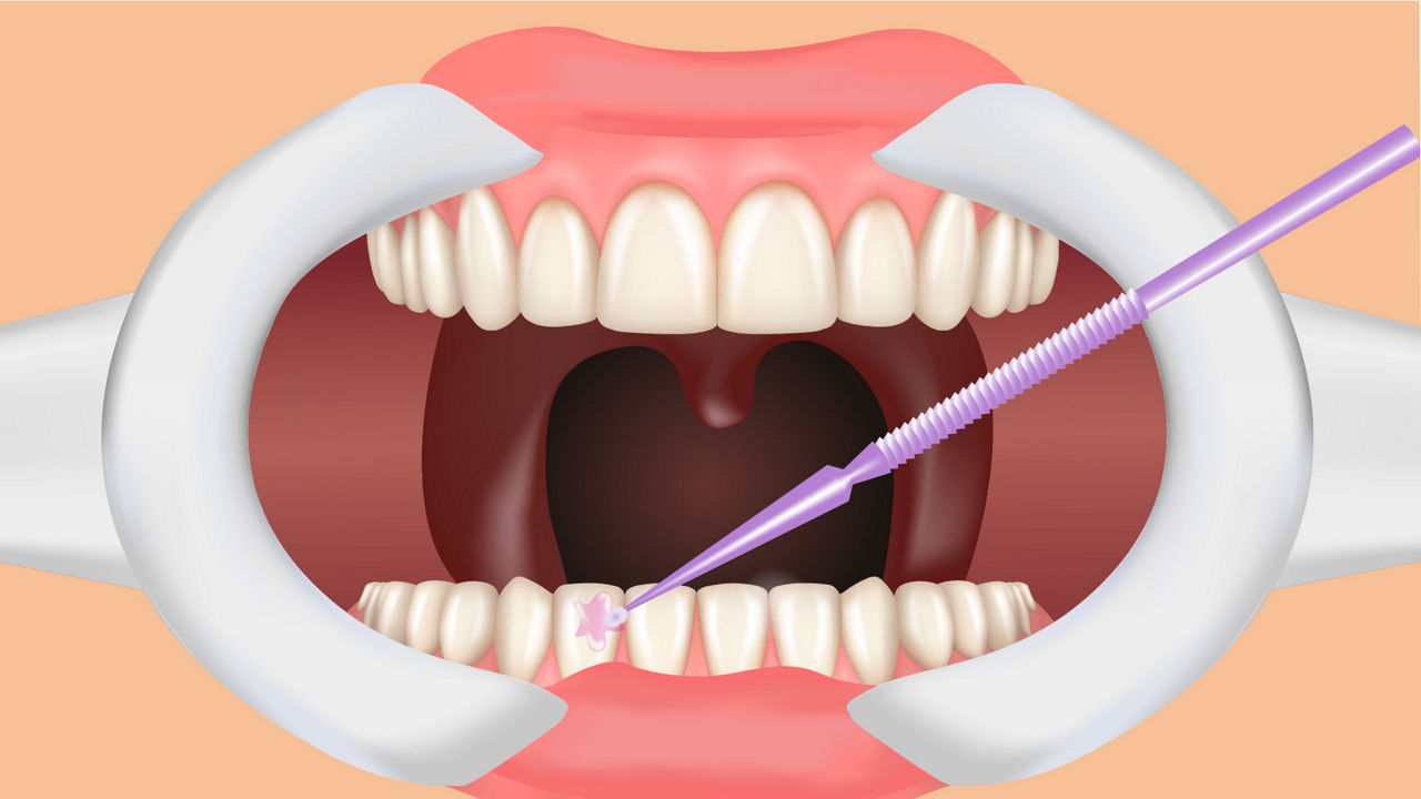 3) Prepare Tooth Surface