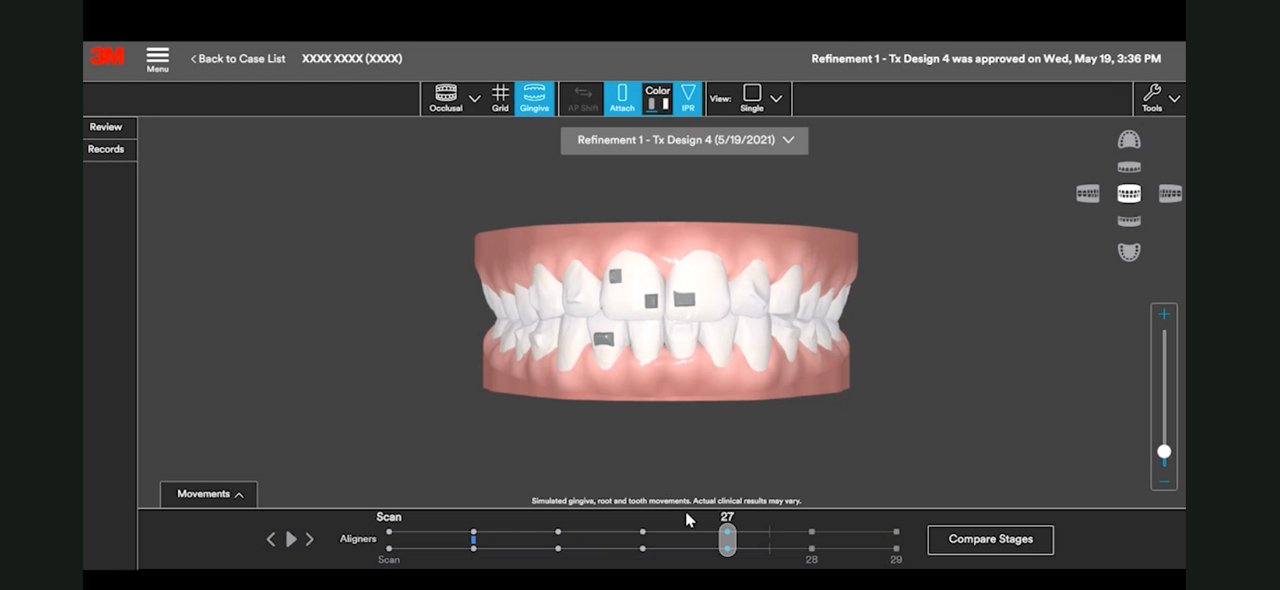 Bøjler på den laterale fortænder på en 3M™ Oral Care Portal brugergrænsefladeskærm, Forfining, Behandlingsplan, Digital Tx Design, rgb, png