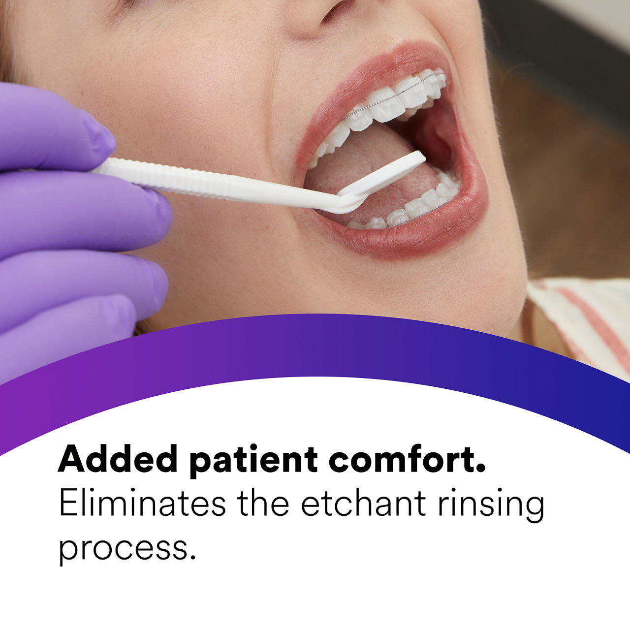 (3) Transbond Plus Self-Etching Primer: Added patient comfort eliminates  etchant rinsing