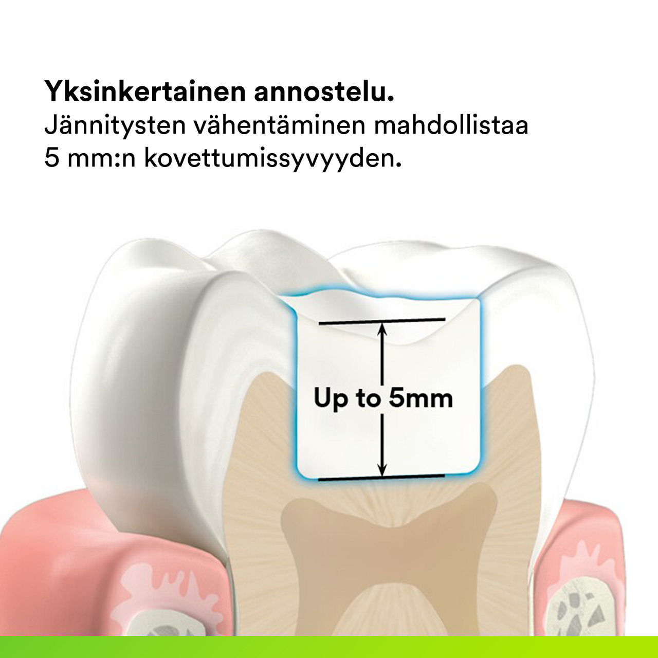 (2) 3M™ Filtek™ One Bulk Fill: Yksinkertainen yksivaiheinen asettaminen.