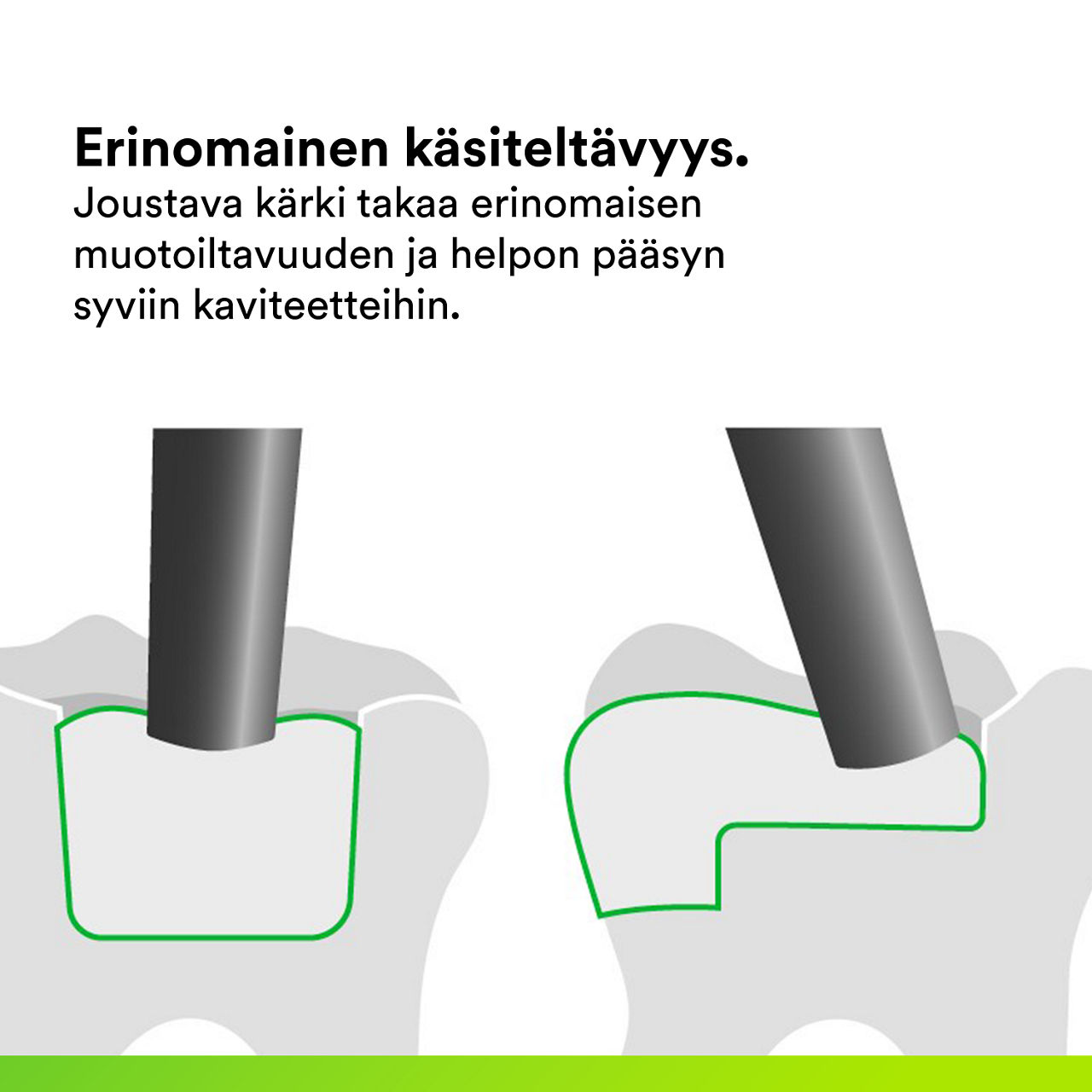 (4) 3M™ Filtek™ One Bulk Fill: Erinomainen käsiteltävyys.