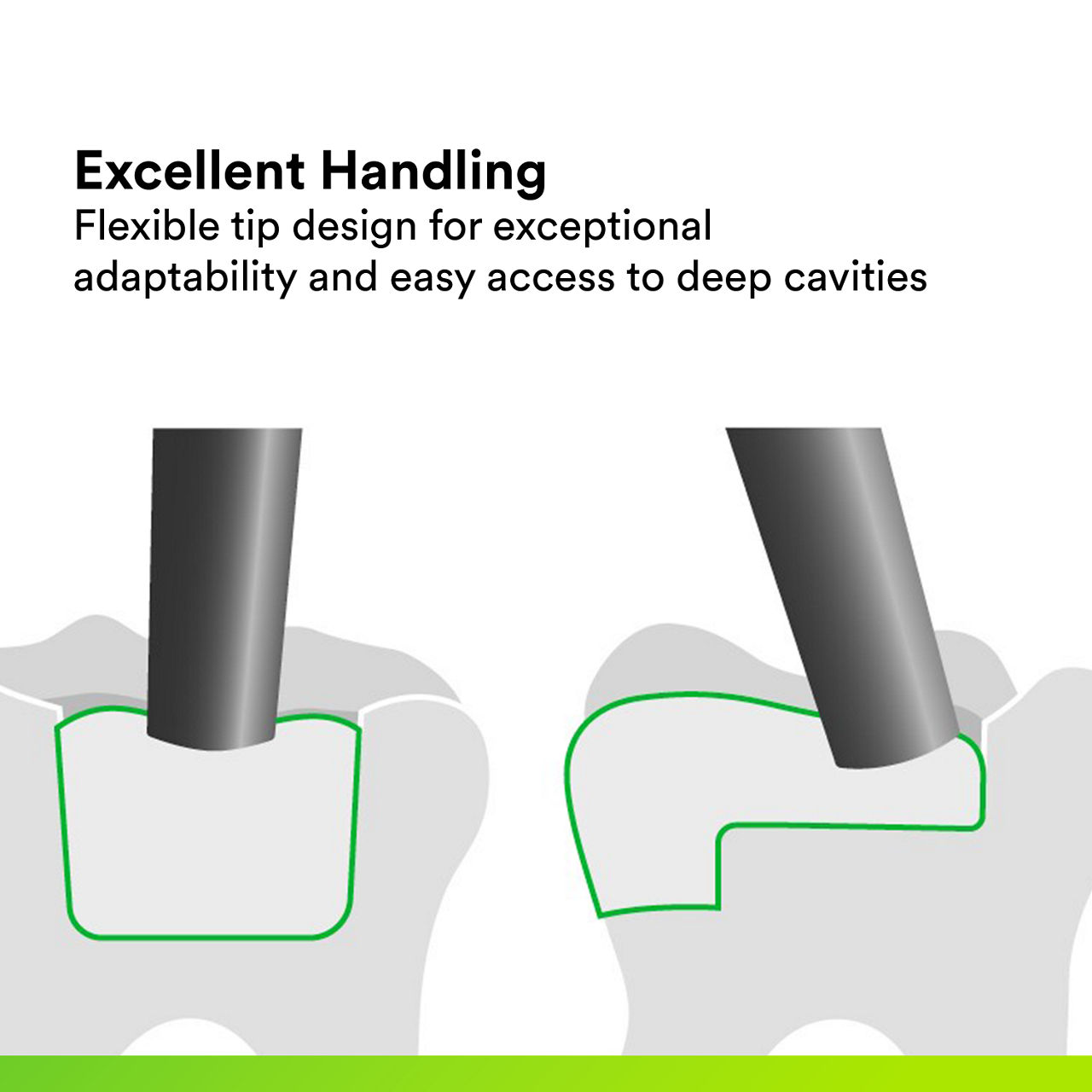 (4) 3M™ Filtek™ One Bulk Fill: Excellent Handling