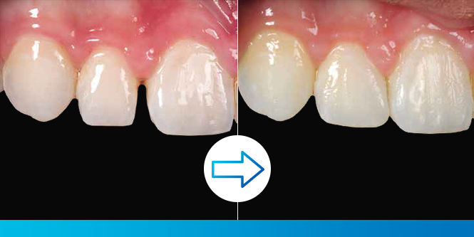 Acceda a este estudio de caso:  Cierre de diastema lateral 