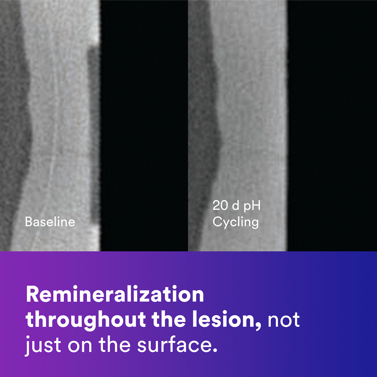 2 - Clinpro 5000: Remineralization throughout the lesion, not just on the surface