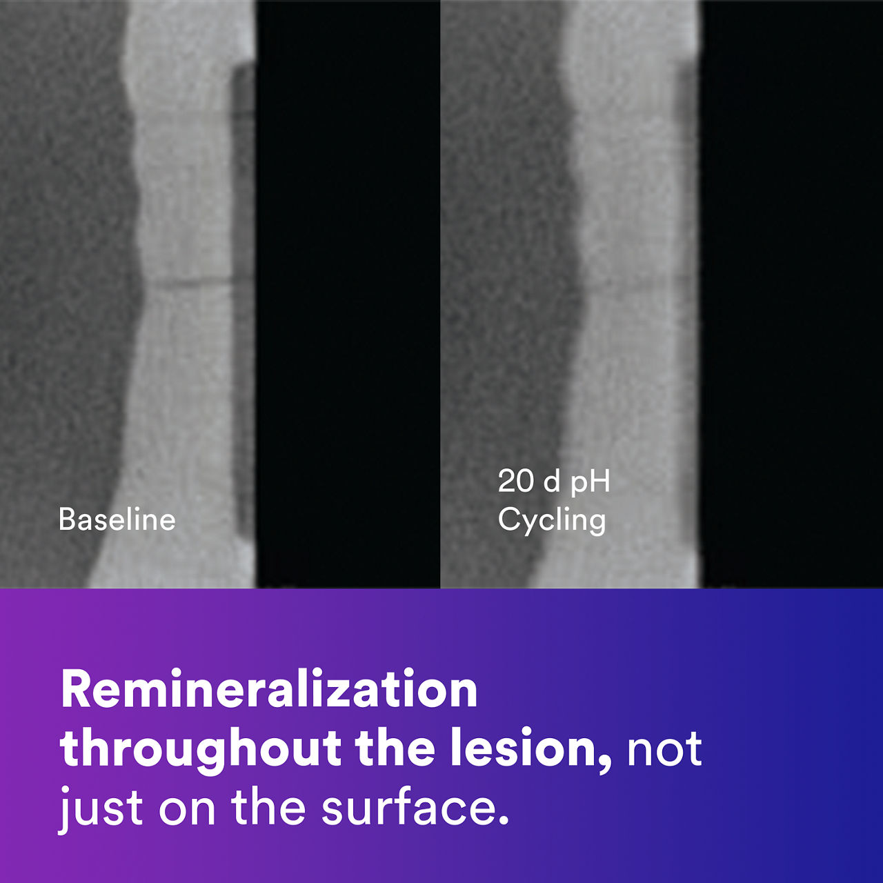 2 - Clinpro Tooth Crème: Remineralization throughout the lesion, not just on the surface