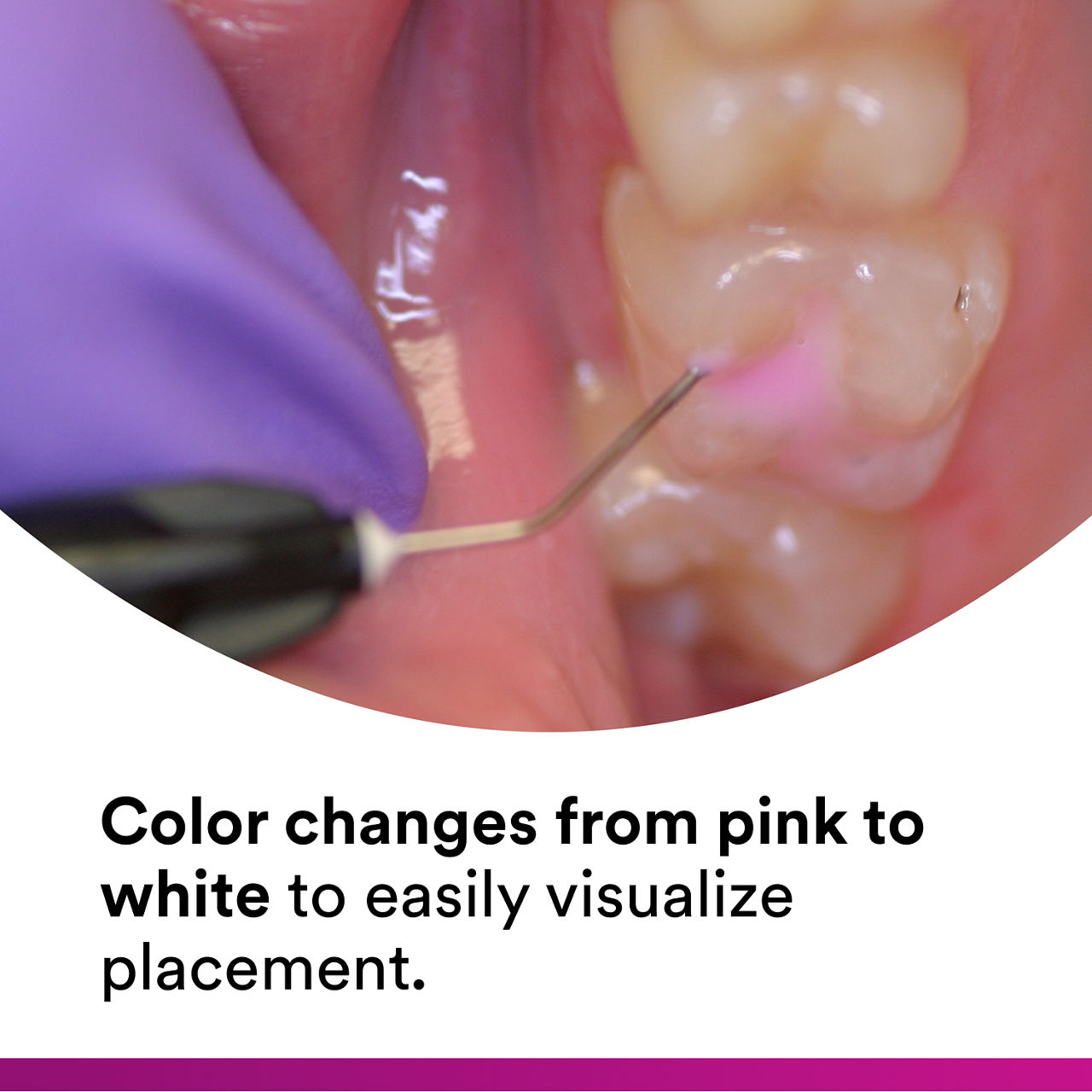 (2) Clinpro Sealant: Color changes from pink to white to easily visualize placement