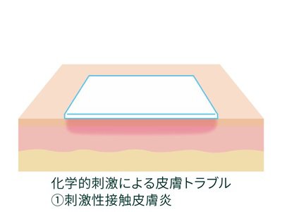 化学的刺激による皮膚トラブル(刺激性接触皮膚炎)のイメージ画像です